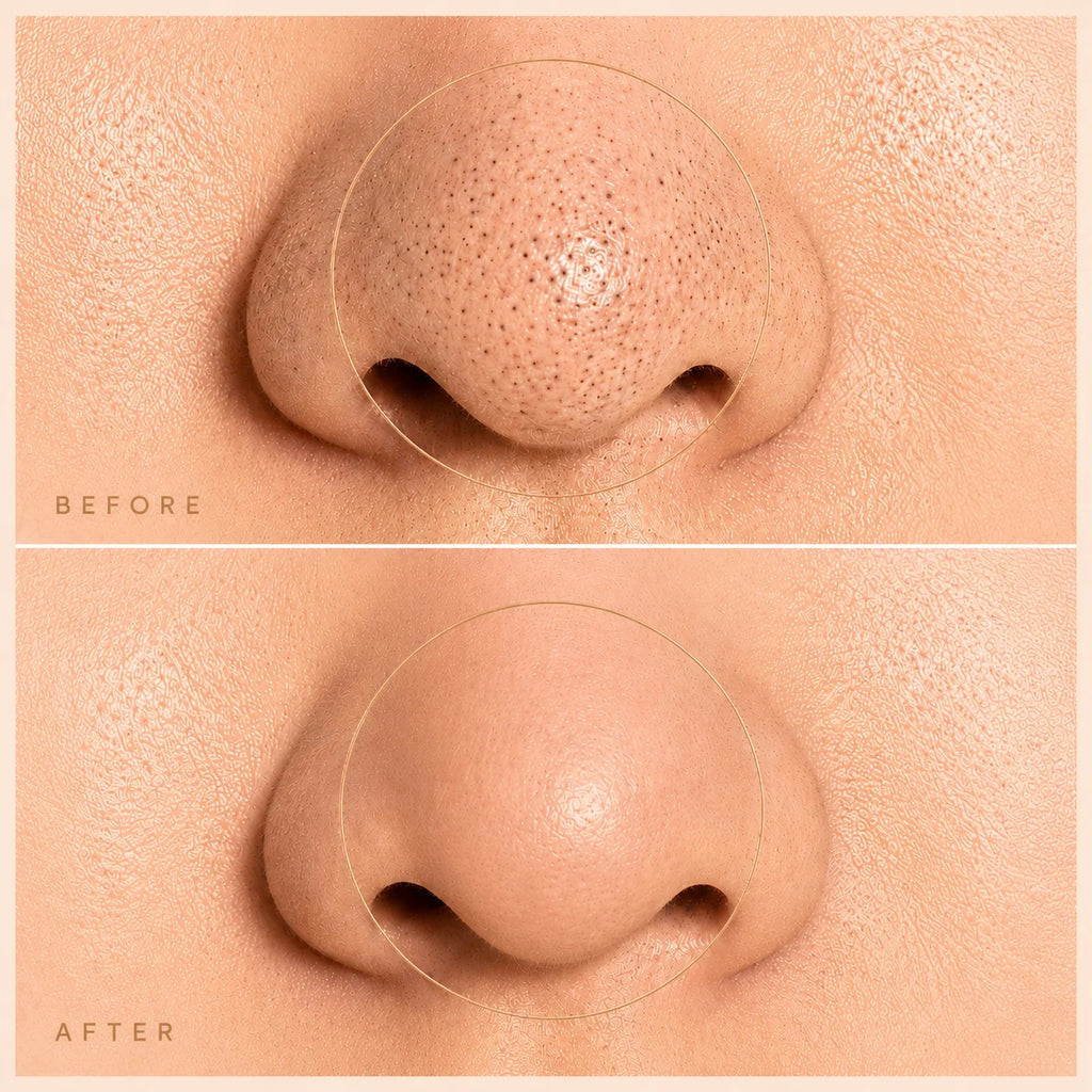 Before and after close-up of nose showing blackheads removed and pores visibly reduced after using the PoreClear pore vacuum